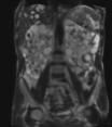 MRI of cystic kidneys in ADPKD (image radiopaedia.org)