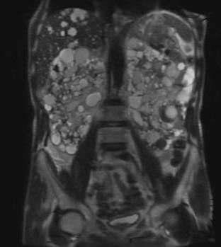 MRI of cystic kidneys in ADPKD (image radiopaedia.org)