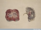 Watercolour drawing showing two views of a polycystic kidney. One view shows the external surface of the kidney, the other when the organ is bisected. 1880 George Francis Teniswood (Wellcome Images)